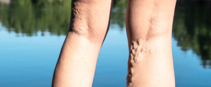 piernas por atrás con varices