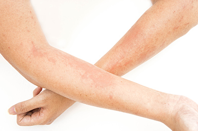 Brazos con manchas - celulitis infecciosa