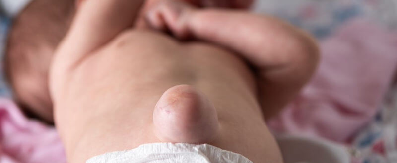 Hernias en recién nacidos y niños ¿Qué son, por qué suceden y como tratarlas?
