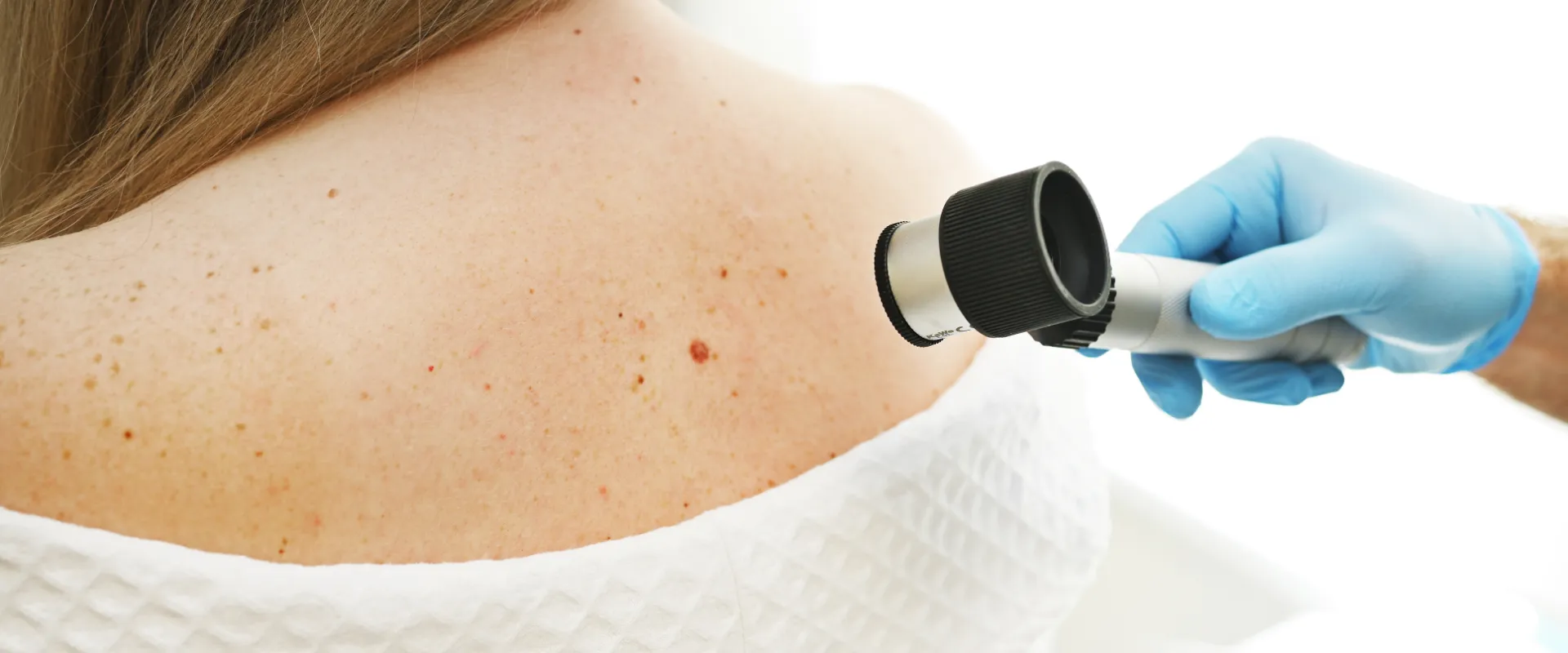 Melanoma en mujeres: ¿por qué las piernas son la zona de mayor riesgo?