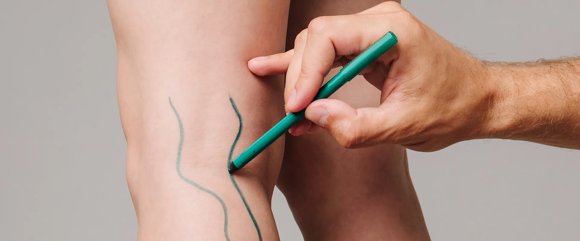 ¿piernas-hinchadas-y-pesadas_-una-cirugía-vascular-puede-ser-la-solución-indisa