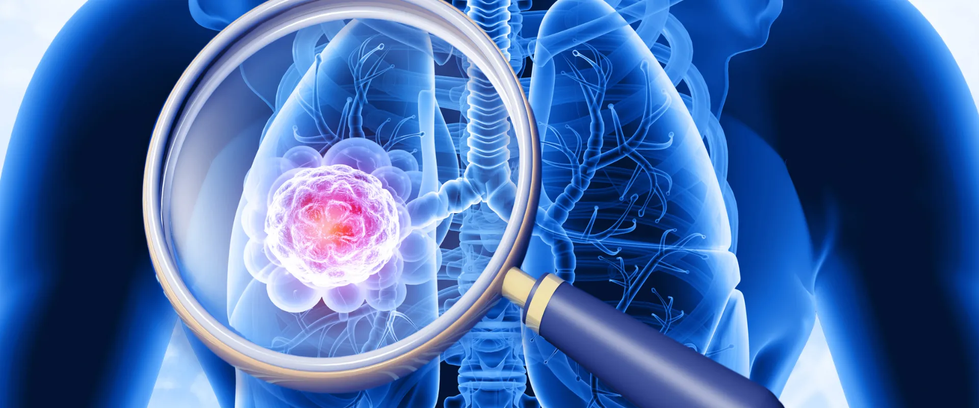 20260210 banner nota Cáncer de pulmón INDISA