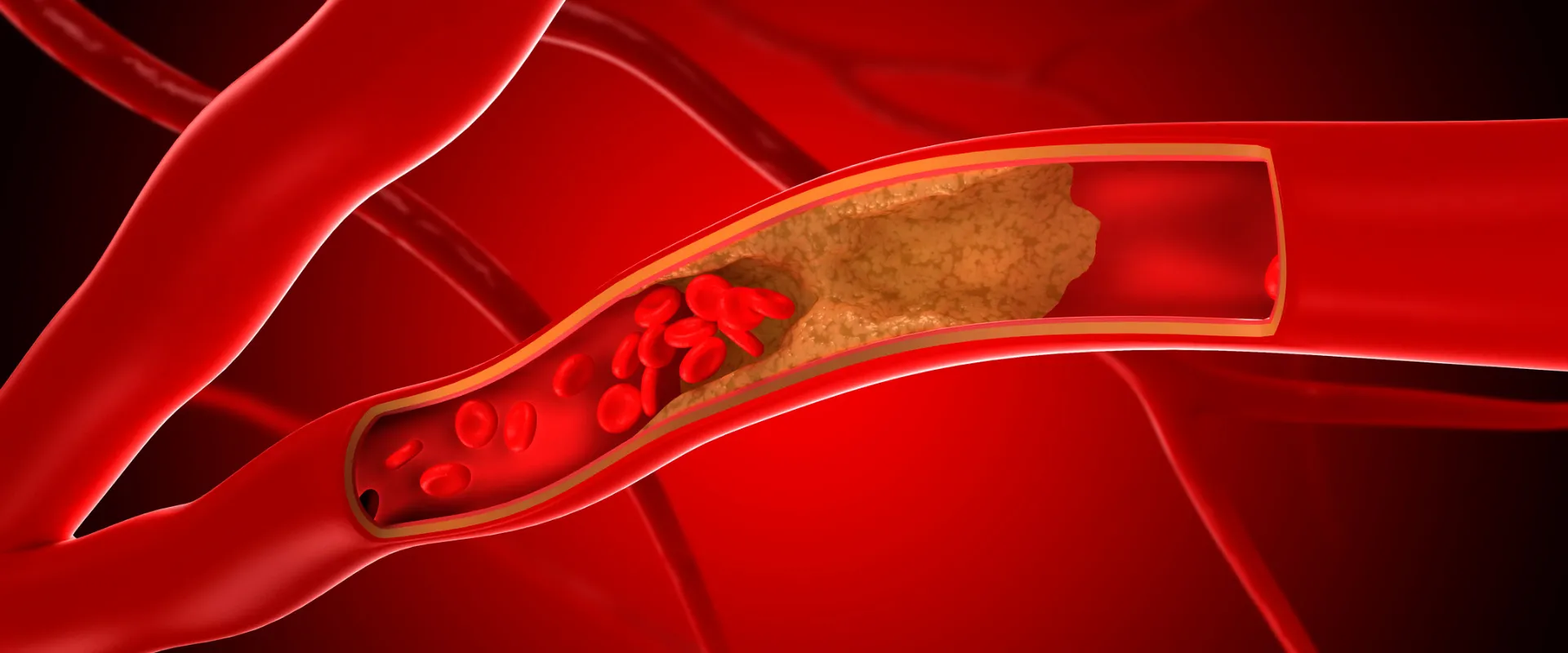 20260413 banner enfermedad vascular blog INDISA