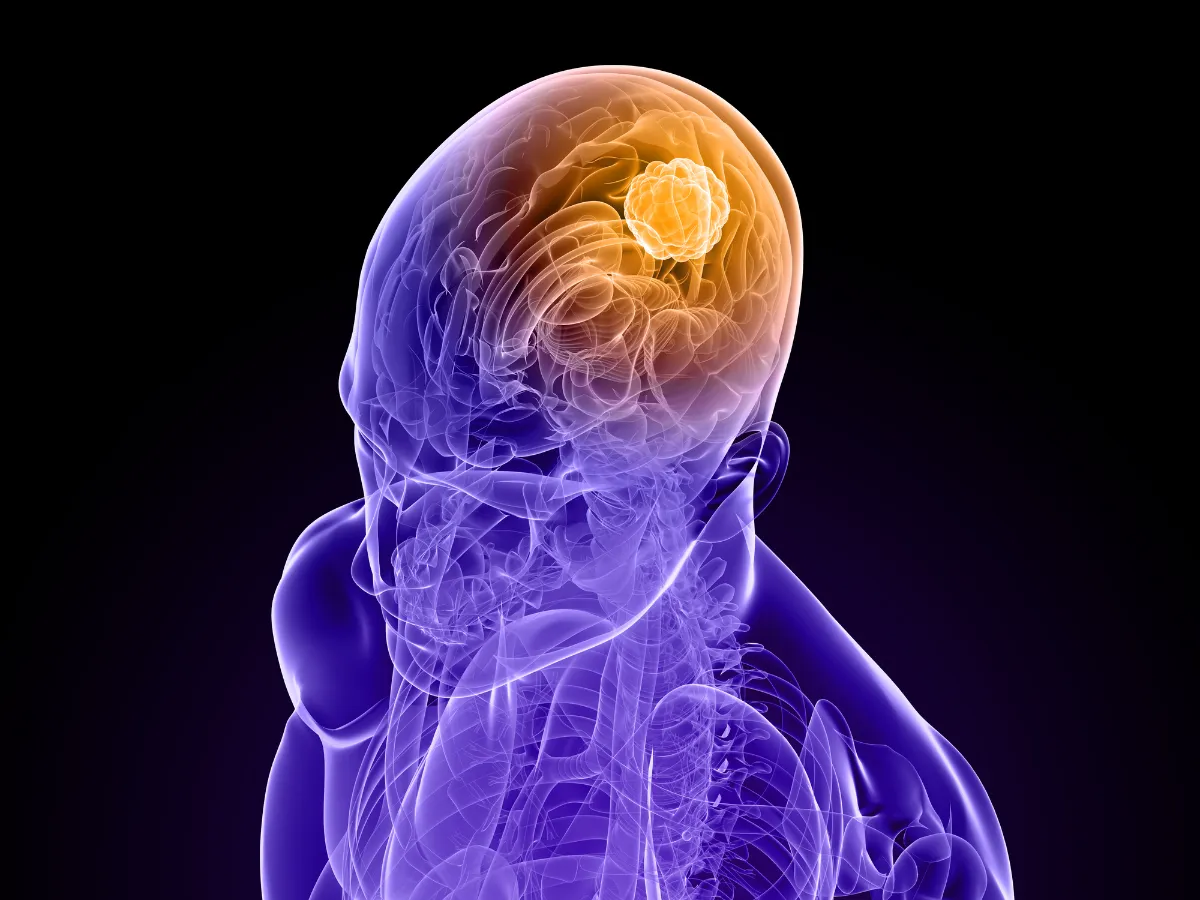 Hablemos de… Tumores Cerebrales