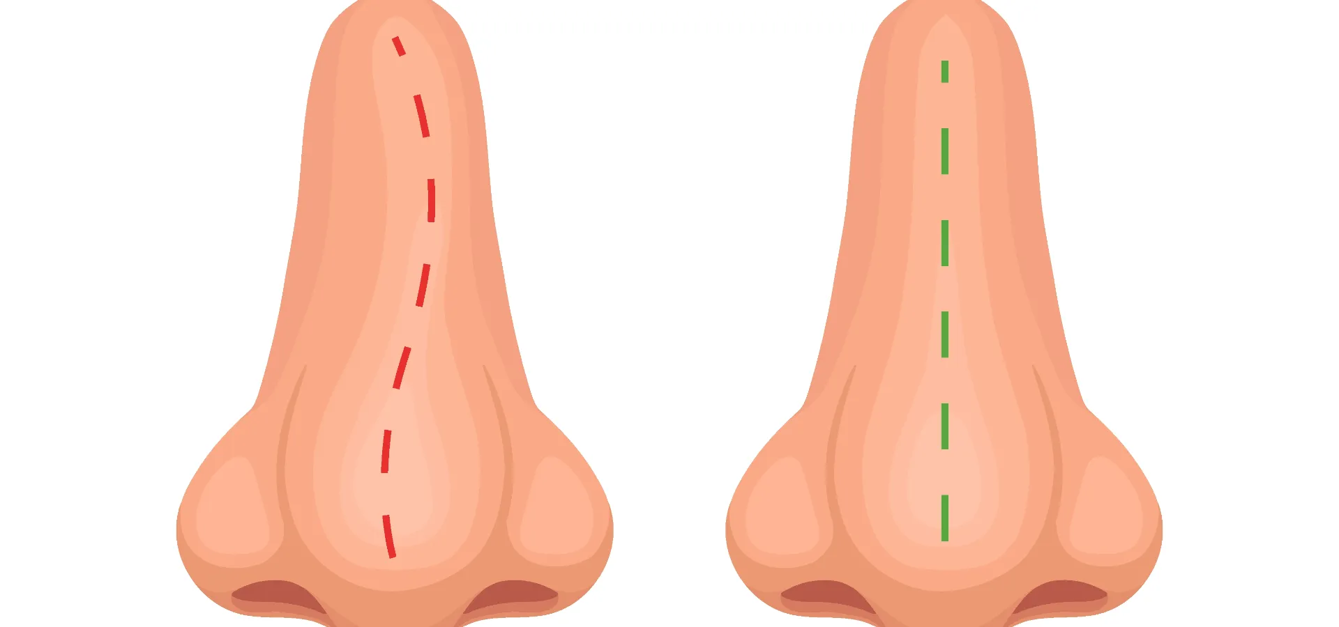 Septoplastia: la cirugía que puede transformar tu respiración y mejorar tu calidad de vida