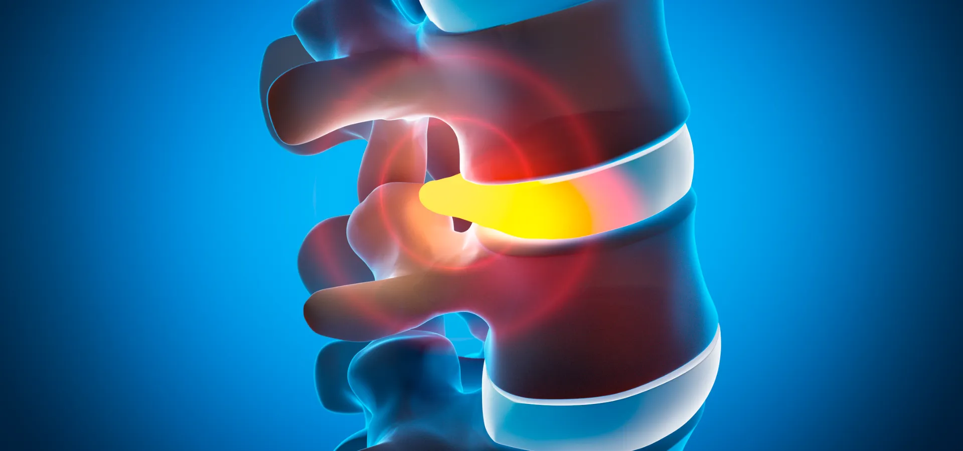 ¿Dolor de espalda o una hernia discal_ Cuándo es momento de consultar a un neurocirujano INDISA