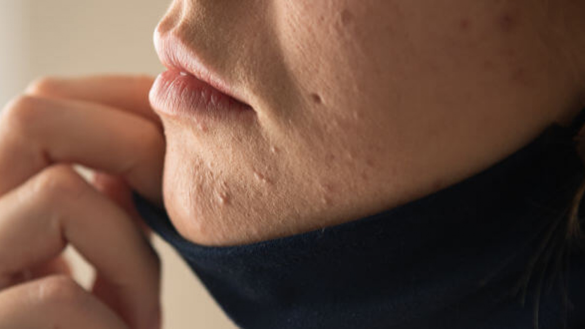 receta aguacero todos los días Sufres de acné por mascarilla o maskné? ¡aprende cómo combatirlo! - Clínica  INDISA - Clínica de familia