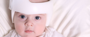 bebé con casco corrector